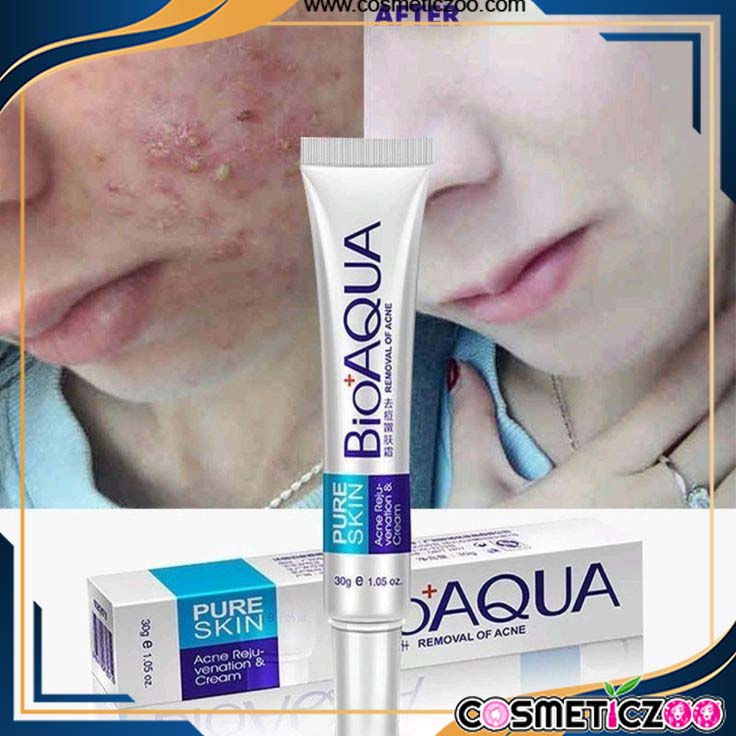 BioAqua Pure Skin Acne Removal Cream